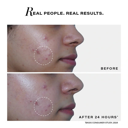 Novology Acne Rescue Spot Corrector Gel for Active Acne Pimples