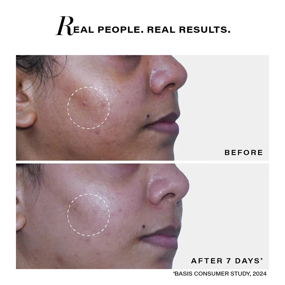 Novology Acne Deep Clearing Cleanser with TT2 Technology for Skin