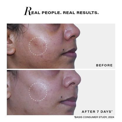 Novology Acne Deep Clearing Cleanser with TT2 Technology for Skin