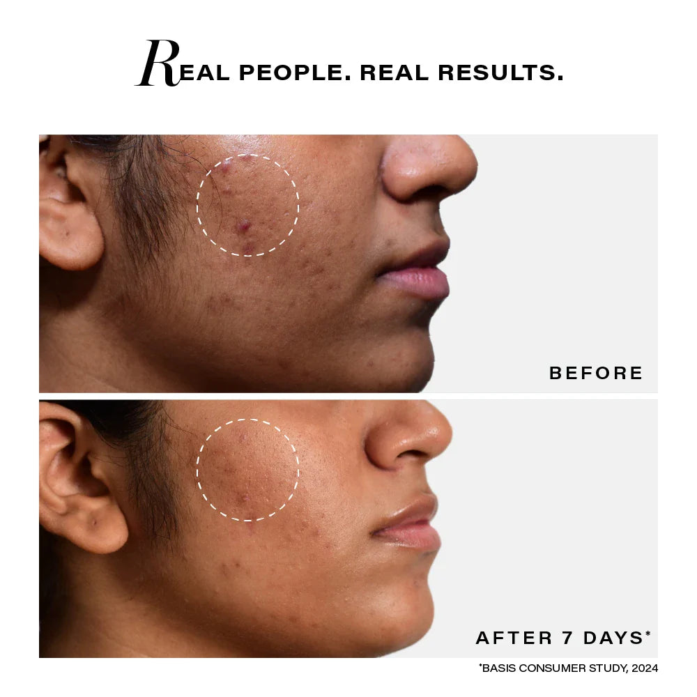 Novology Acne Clearing Serum with 0.1% Thymol and Terpineol