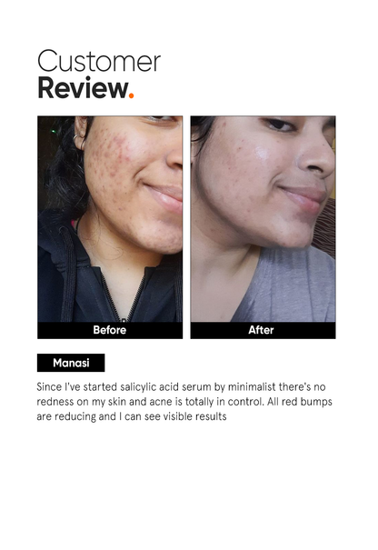 Minimalist Salicylic Acid 2% Face Serum for Acne and Blackheads