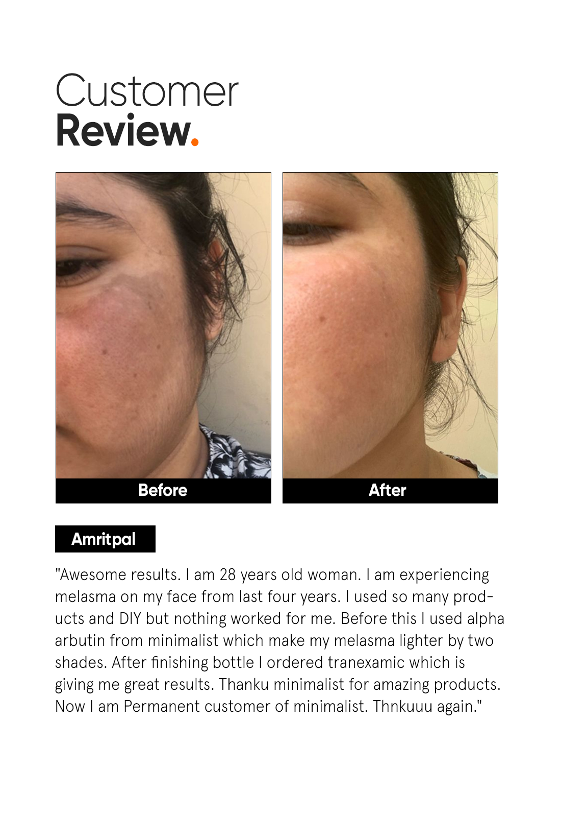Minimalist 3% Tranexamic Acid Serum for Melasma and Acne Scars