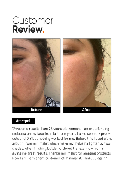 Minimalist 3% Tranexamic Acid Serum for Melasma and Acne Scars